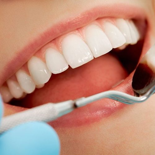 Close-up of patient’s open mouth during oral checkup with mirror near by